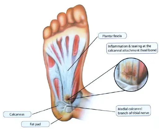 plantar fasciitis diagram