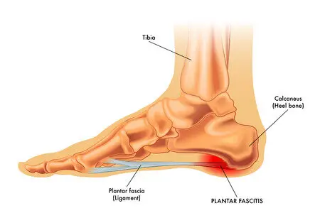 પગનાં તળિયાંને લગતું ફેશીઆઇટિસ: ફિઝીયોથેરાપી સારવાર