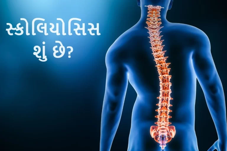 સ્કોલિયોસિસ (Scoliosis)