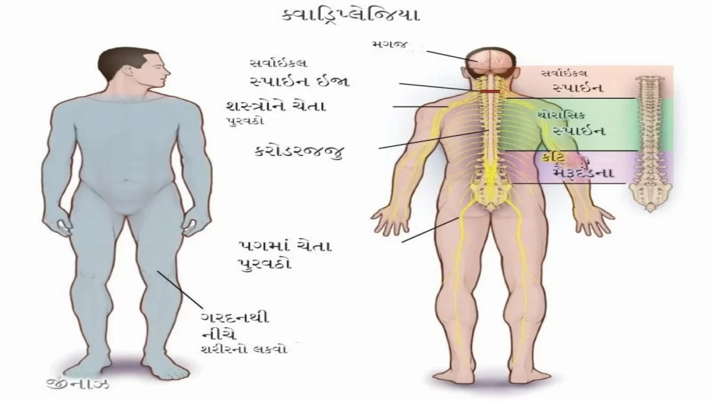 ક્વાડ્રિપ્લેજિયા