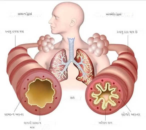 અસ્થમા