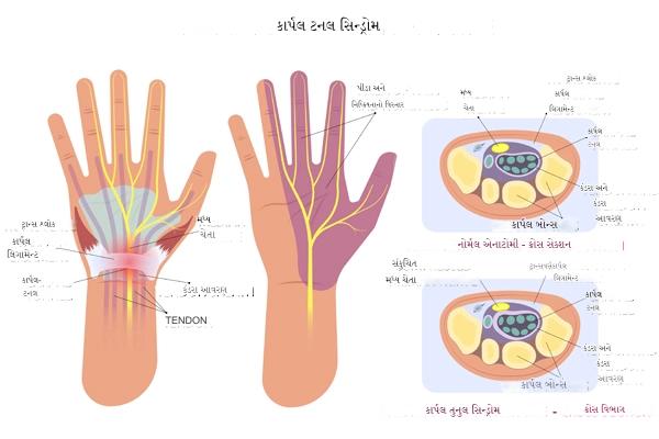કાર્પલ ટનલ સિન્ડ્રોમ