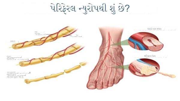 પેરીફેરલ ન્યુરોપથી