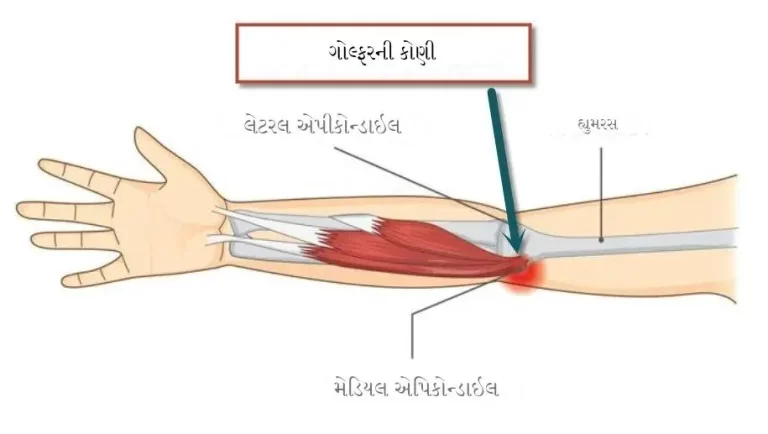 ગોલ્ફર એલ્બો