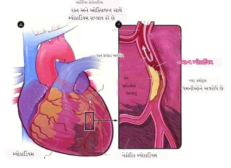 હદય રોગનો હુમલો (હાર્ટ ઍટેક)