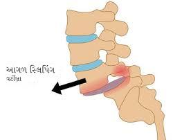 સ્પોન્ડીલોલિસ્થેસિસ