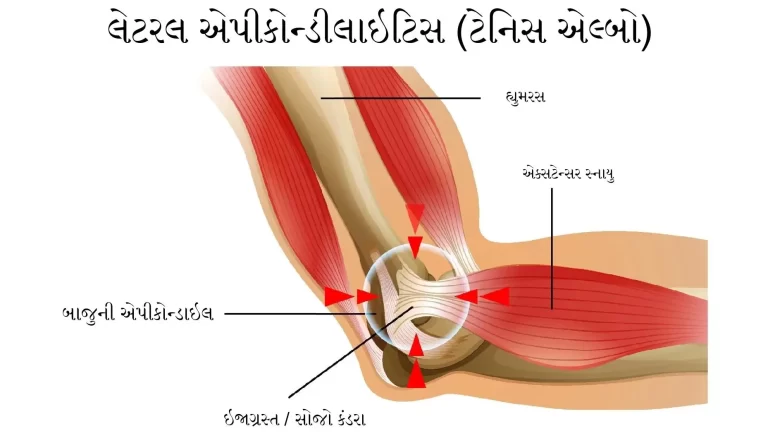 ટેનિસ એલ્બો