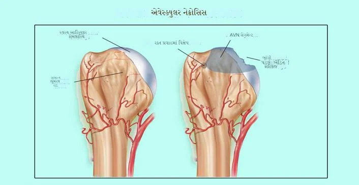 એવસ્ક્યુલર નેક્રોસિસ