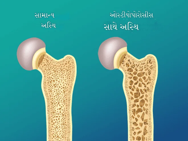 ઓસ્ટીયોપોરોસીસ