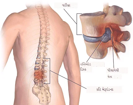 કમરના મણકાનો દુખાવો