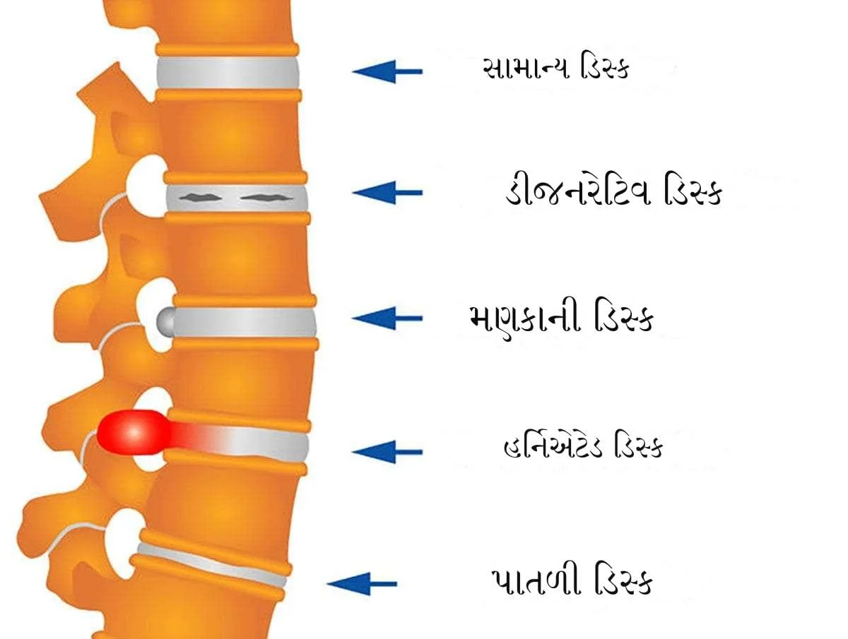 કમરની ગાદીનો દુખાવો