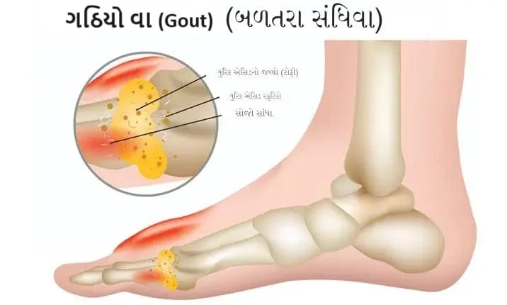 ગઠિયો વા (Gout)