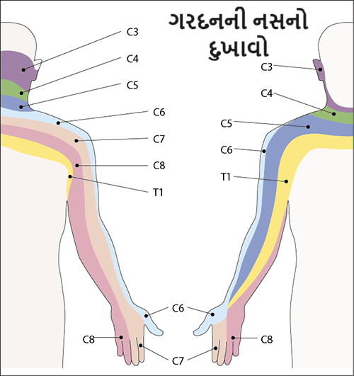 ગરદનની નસનો દુખાવો