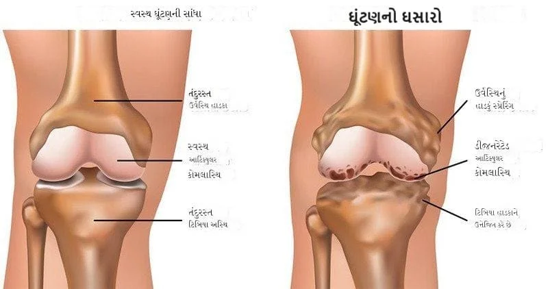 ઘૂંટણનો ઘસારો