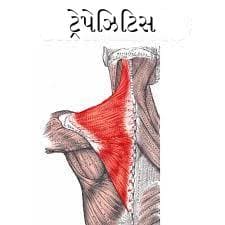 ટ્રેપેઝિયસ સ્નાયુનો દુખાવો