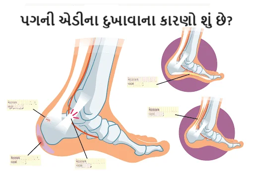 પગની એડીનો દુખાવો (Heel Pain)