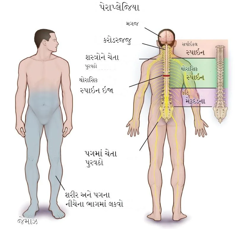 પેરાપ્લેજિયા