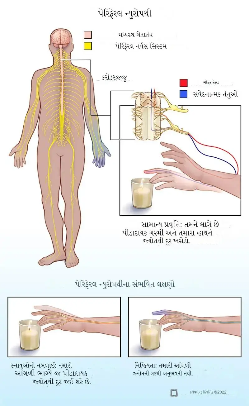 પેરિફેરલ ન્યુરોપથી