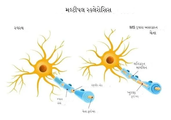 મલ્ટીપલ સ્ક્લેરોસિસ