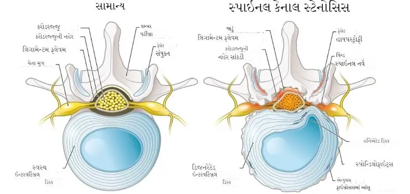 લમ્બર કેનાલ સ્ટેનોસિસ (Lumbar Canal Stenosis)