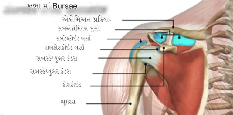 સબએક્રોમિયલ બર્સિટિસ