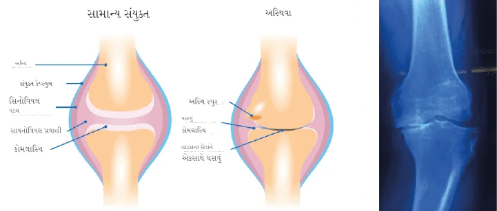 હાડકા નો ઘસારો