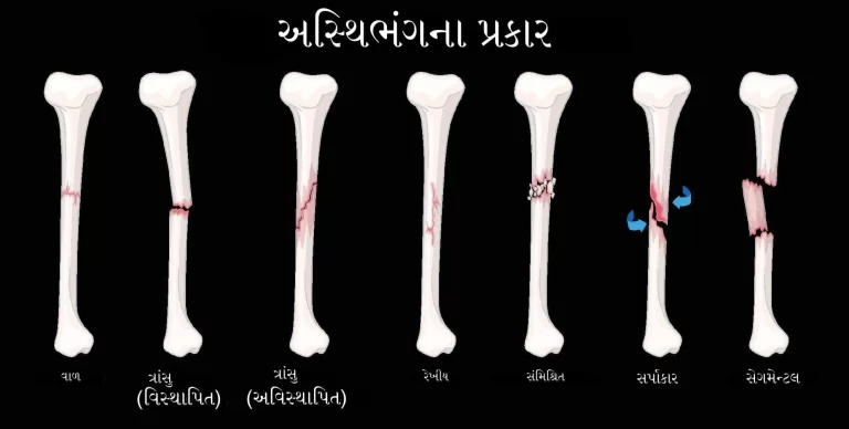 હાડકાનું ફ્રેક્ચર