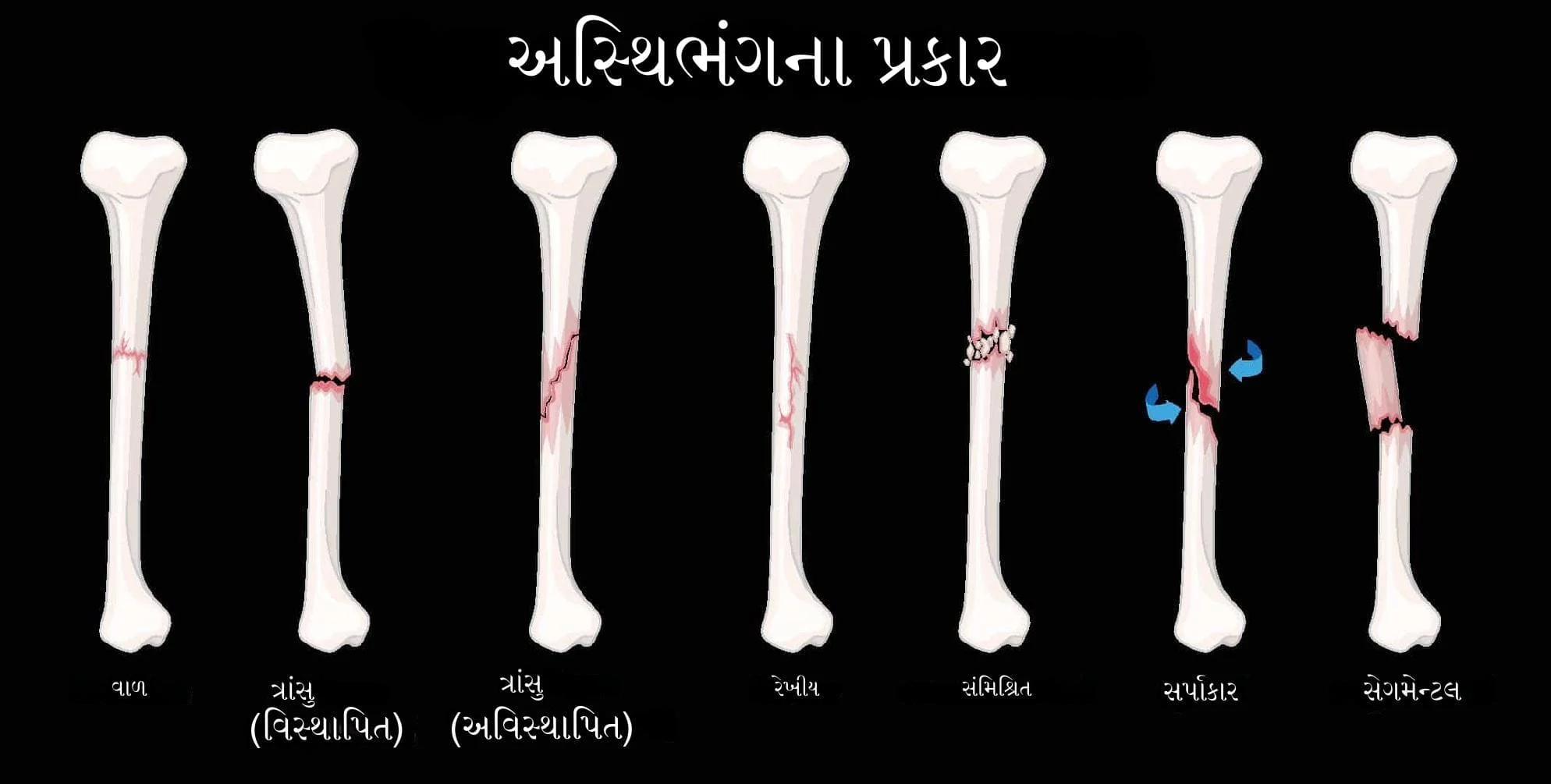 હાડકાનું ફ્રેક્ચર