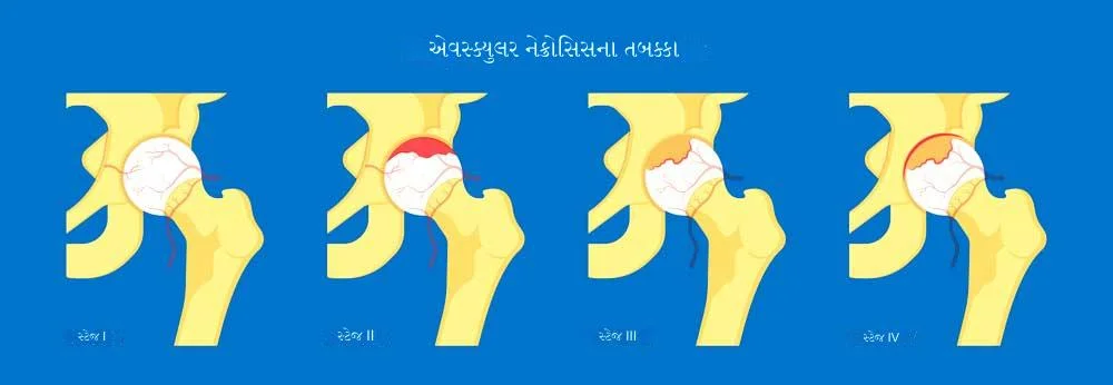 હિપમાં એવસ્ક્યુલર નેક્રોસિસના તબક્કા