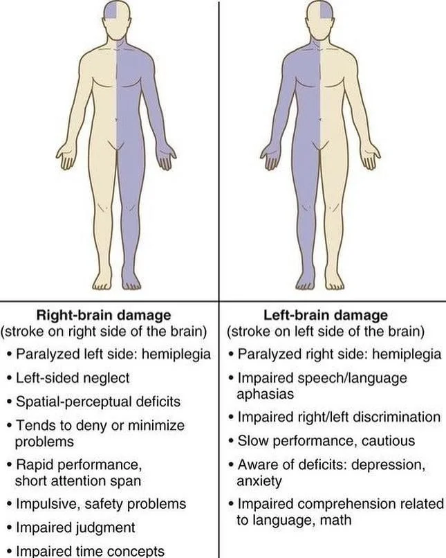 હેમિપ્લેજિયા (Hemiplegia)