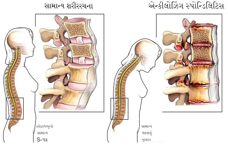 એન્કીલોઝિંગ સ્પોન્ડિલાઈટિસ (Ankylosing spondylitis)