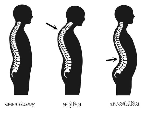 કાયફોસિસ