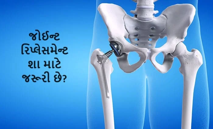 જોઈન્ટ રિપ્લેસમેન્ટ