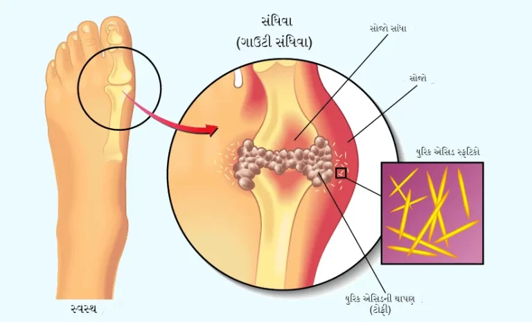 યુરિક એસિડ