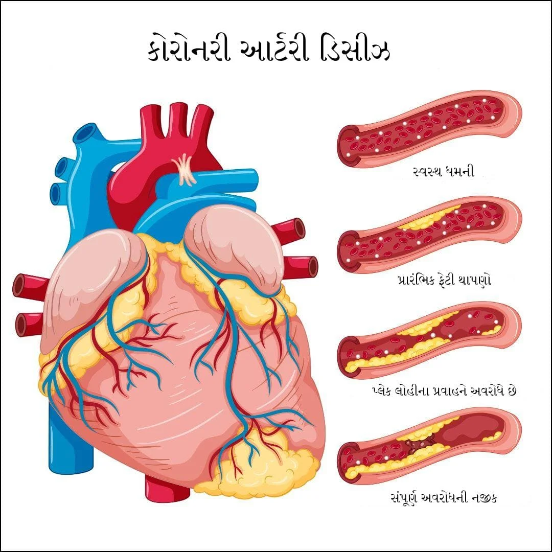 કોરોનરી ધમની રોગ (CAD)