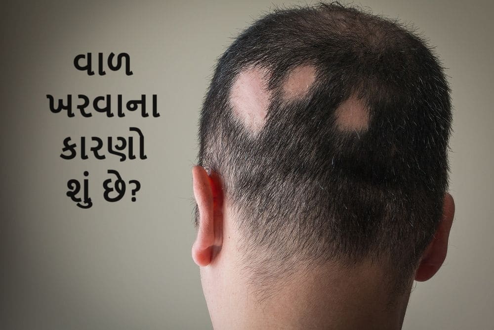 વાળ ખરવા