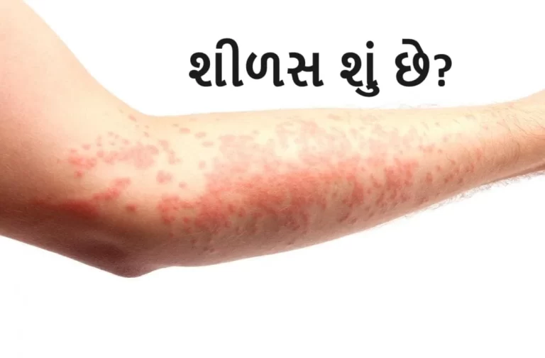 શીળસ