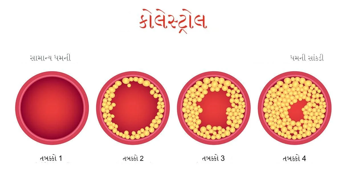 કોલેસ્ટ્રોલ થવાના કારણો