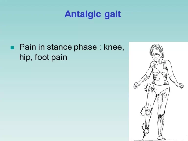 લંગડાતી ચાલ