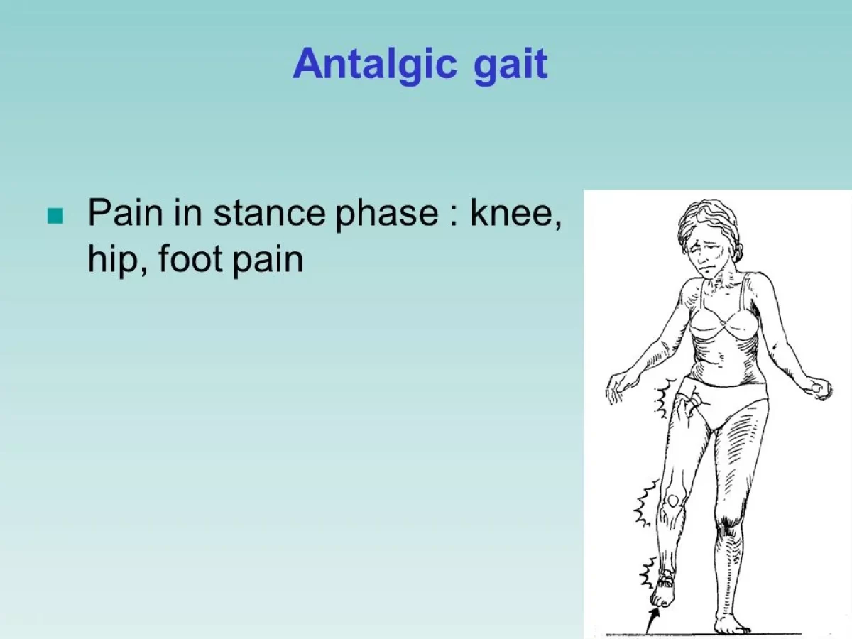 લંગડાતી ચાલ