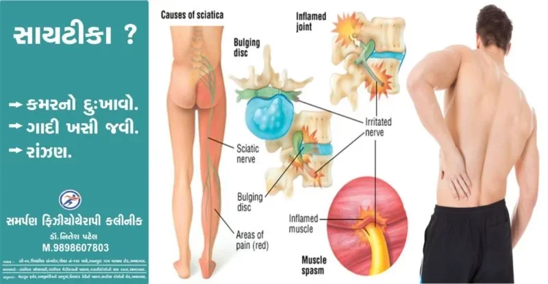 સાયટીકાના દુખાવાની સારવાર