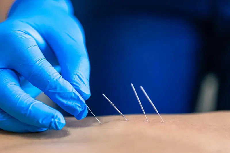 ડ્રાય નીડલિંગ (Dry Needling)