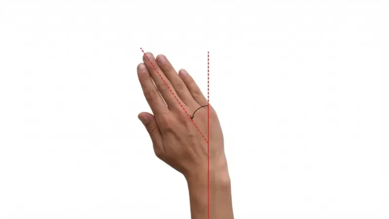 રેડિયલ ડેવિએશન