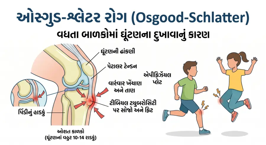 ઓસ્ગુડ-શ્લેટર રોગ (Osgood-Schlatter) વધતા બાળકોમાં ઘૂંટણના દુખાવાનું કારણ