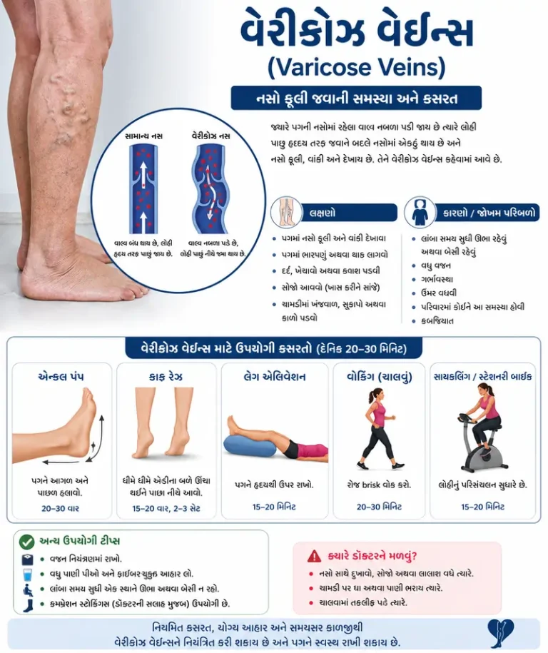 વેરીકોઝ વેઇન્સ (Varicose Veins): નસો ફૂલી જવાની સમસ્યા અને કસરત