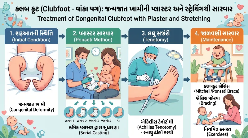 ક્લબ ફૂટ (Clubfoot - વાંકા પગ) જન્મજાત ખામીની પ્લાસ્ટર અને સ્ટ્રેચિંગથી સારવાર.
